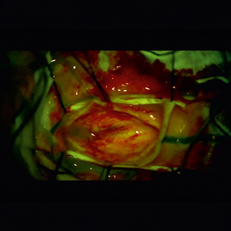 Современная система визуализации для нейрохирургии ZEISS TIVATO 700